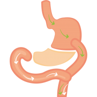 Biliopankreatska preusmeritev  (Biliopancreatic Diversion)