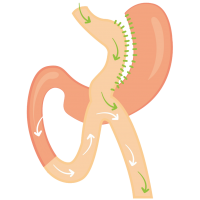 Mini želodčni obvod